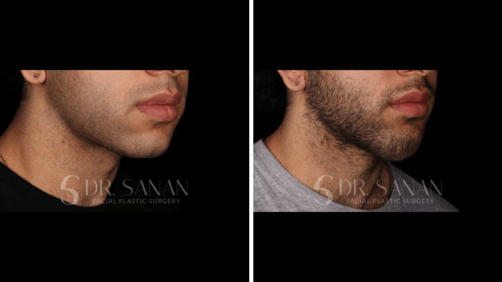 Chin Augmentation Boston MA